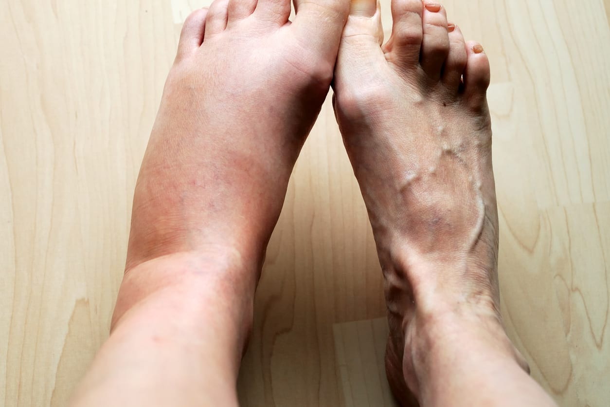 Kenali Ciri Kaki Bengkak Karena Ginjal dan Cara Mengatasinya