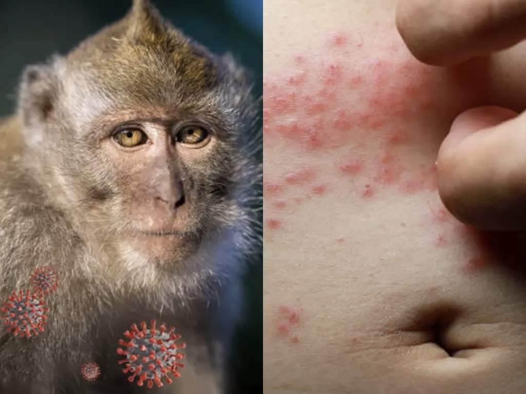 jakarta-monkeypox-cases-goes-up-as-patients-contracted-the-virus-through-sexual-interactions