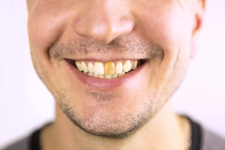 gigi kuning mengganggu penampilan